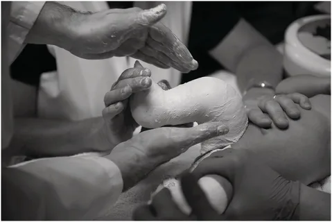 روش‌های غیرجراحی در درمان پای پرانتزی کودکان