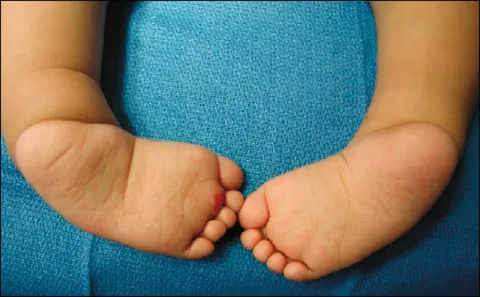 نحوه استفاده از روش جراحی در درمان پای پرانتزی کودکان