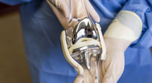 آمادگی لازم برای جراحی تعویض مفصل